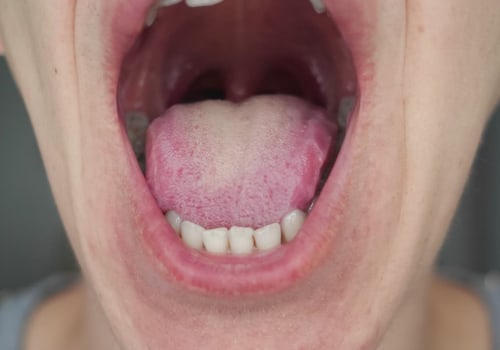 What are the symptoms of covid-19 in the mouth?